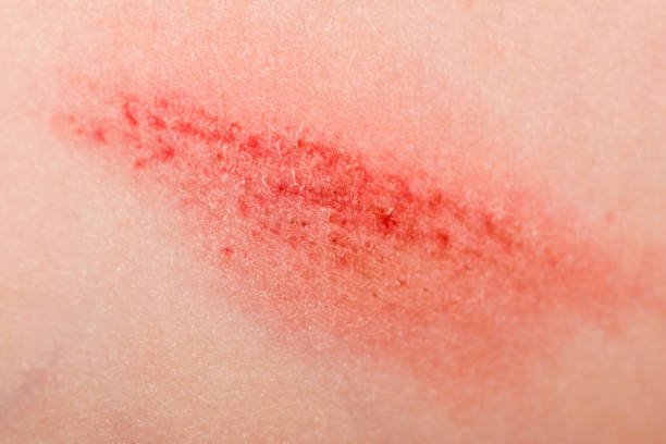 a wound on the human body. very close up of painful wound.